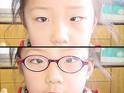 斜视眼