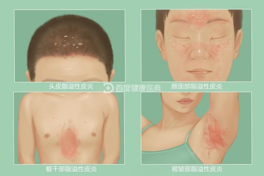 脂溢性皮炎