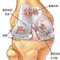 内风湿病