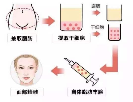 自体脂肪