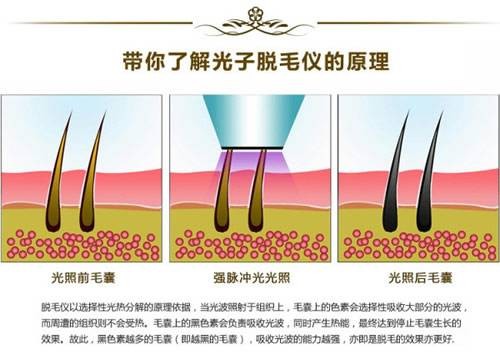 光子脱毛