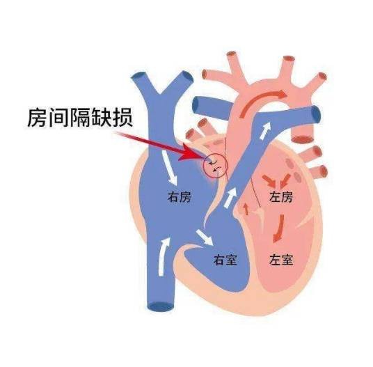 房间隔缺损