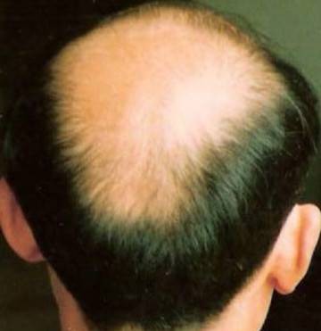 秃发（毛发疾病）