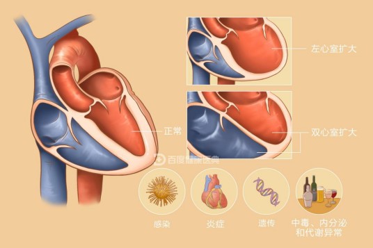 扩张型心肌病
