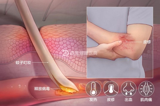 登革热(急性虫媒传染病)