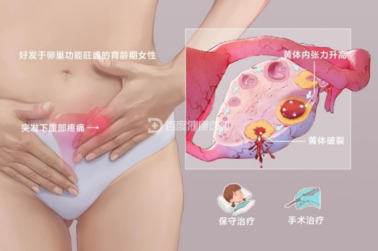 黄体破裂