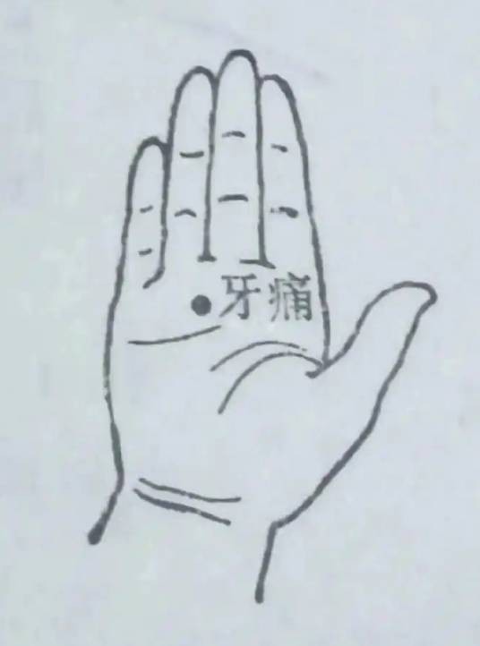 牙痛穴