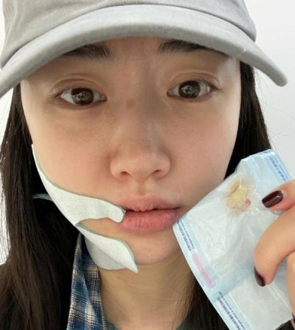 景甜拔完智齿晒素颜照，终于有机会吃雪糕，曾为整容而后悔