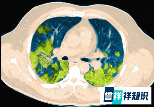 那幅大脑黑白马赛克图如何永远改变了医学?