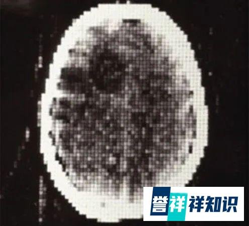 那幅大脑黑白马赛克图如何永远改变了医学？