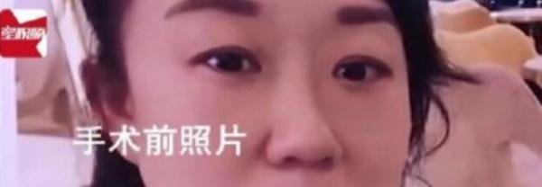 怎么总有这种事啊?“隆胸失败、双眼皮失败老公闹离婚”,割双眼皮竟然也能成为离婚的理由?